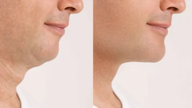Neck Lifts